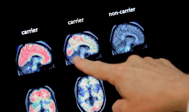 Lecanemab: New Alzheimer's drug slows decline in memory - fuelling hope doctors will one day cure dementia - Vimarsana News