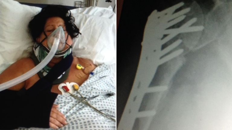 Sharon Cochrane was nearly killed after being hit by a hit-and-run driver. Pics: Sharon Cochrane