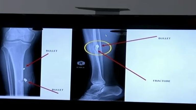 X-ray images show where the bullets lodged in Mr Khan's legs