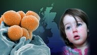 A map reveals the spread of scarlet fever 