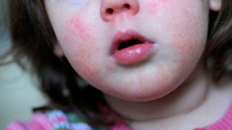 Strep A causes scarlet fever (pictured), which can be treated with antibiotics, but sometimes the bacteria can be life threatening