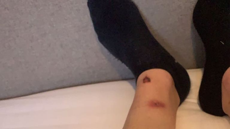 Another patient, who wants to remain anonymous, and was admitted to the Maidenhead unit in 2020, shared photographs of injuries to her legs and knuckles which she says were sustained during restraints