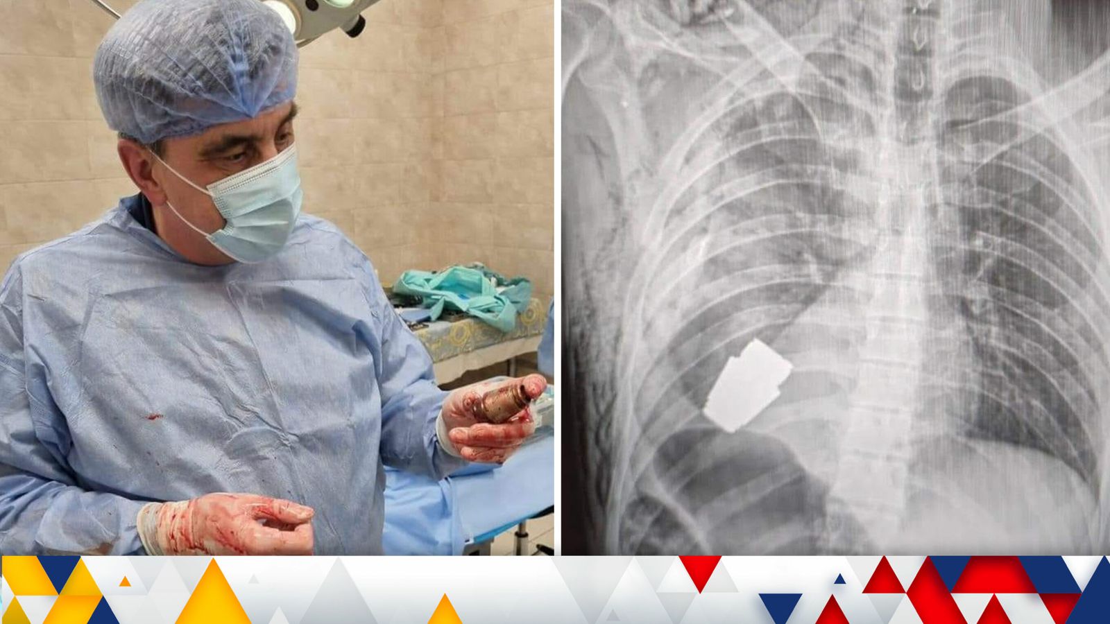 Ukraine war: Surgeon removes 'live grenade' from inside soldier's body