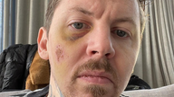 Rapper Professor Green shared this image of himself on Instagram of his injuries following a seizure at his home in April 2022. 