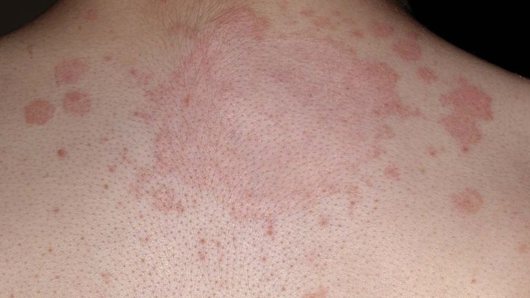 The main symptom of ringworm is a rash that spreads. Image: NHS