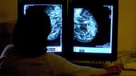File photo dated 15/06/06 of a consultant studying a mammogram of a woman's breast. A record number of cancer patients received treatment last year, but waiting lists were also the longest ever, according to NHS figures. More than 320,000 people received cancer care in the 12 months from November 2021, up by more than 8,000 on the same period from November 2018 - the last pre-pandemic comparison, the health service said. Issue date: Tuesday January 3, 2023.