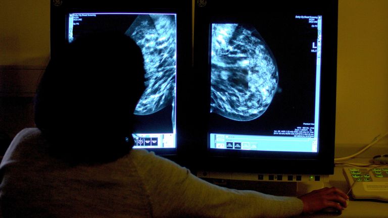 File photo dated 15/06/06 of a consultant studying a mammogram of a woman&#39;s breast. A record number of cancer patients received treatment last year, but waiting lists were also the longest ever, according to NHS figures. More than 320,000 people received cancer care in the 12 months from November 2021, up by more than 8,000 on the same period from November 2018 - the last pre-pandemic comparison, the health service said. Issue date: Tuesday January 3, 2023.