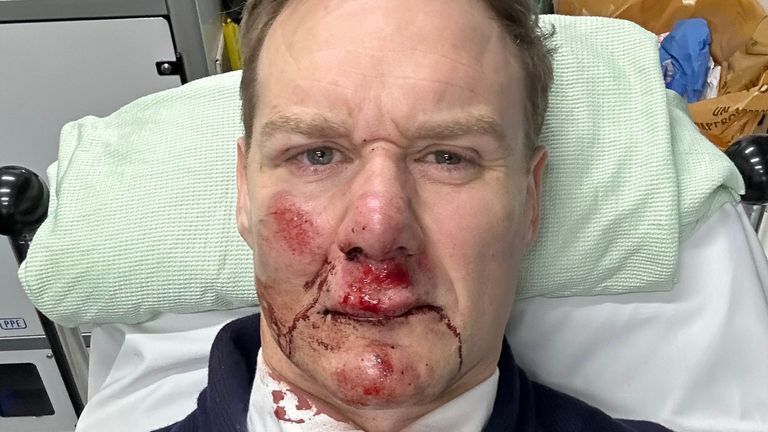 Dan Walker posts pictures on his twitter after he was involved in an accident with a car while riding his bike

