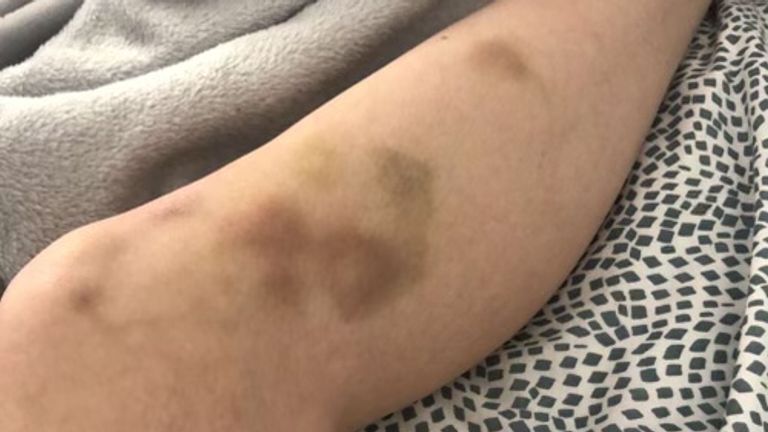 Scarlette's bruises to her legs