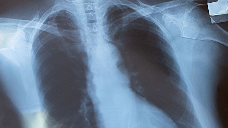 Doctor diagnoses patient's health condition including asthma, lung disease, lung COVID-19, coronavirus or bone cancer disease and uses radiology chest x-ray for healthcare hospital service