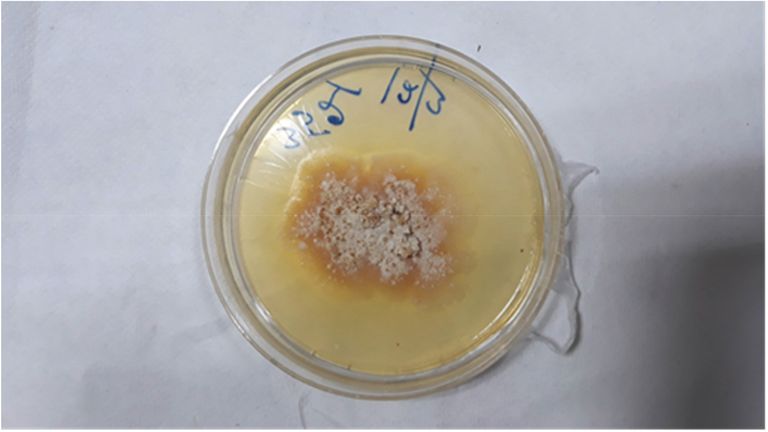 The pus from the man&#39;s abscess was drained and collected in a petri dish