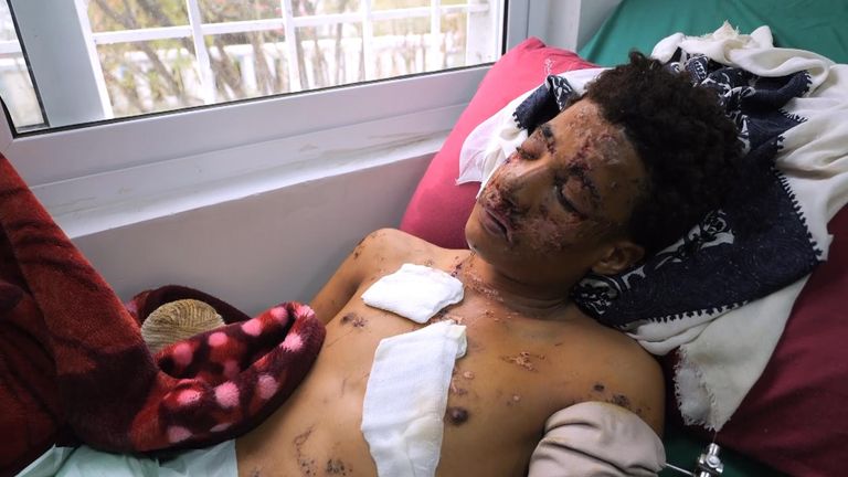 Landmine victim in Yemen
