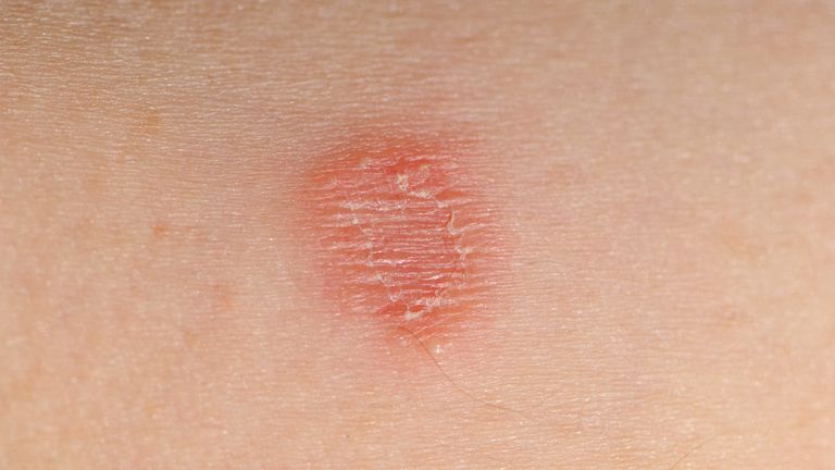 A case of ringworm or ringworm infection.file picture