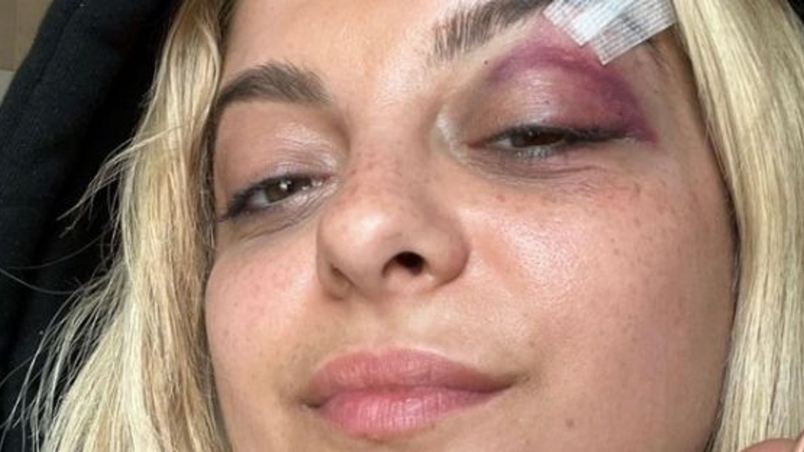Bebe Rexha shows black eye after being hit by phone during New York concert