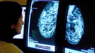 A consultant analysing a mammogram