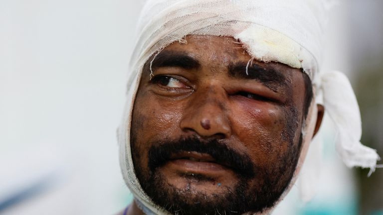 SENSITIVE MATERIAL.  THIS IMAGE MAY OFFEND OR DISTURB Nani Gopal Bari, 38, who was injured in a train collision, sits on a hospital bed in Balasore district in the eastern state of Odisha, India, on June 3, 2023. REUTERS/Adnan Abidi