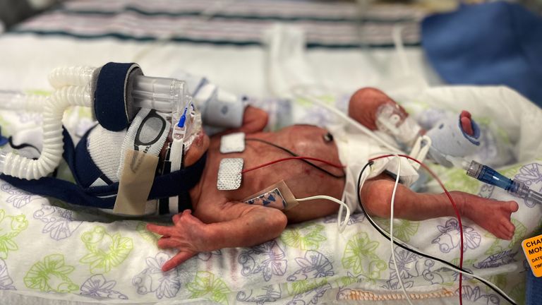 MAYRON HOLLIS _ BABY ELAYNA IN NICU
ABORTION STORY