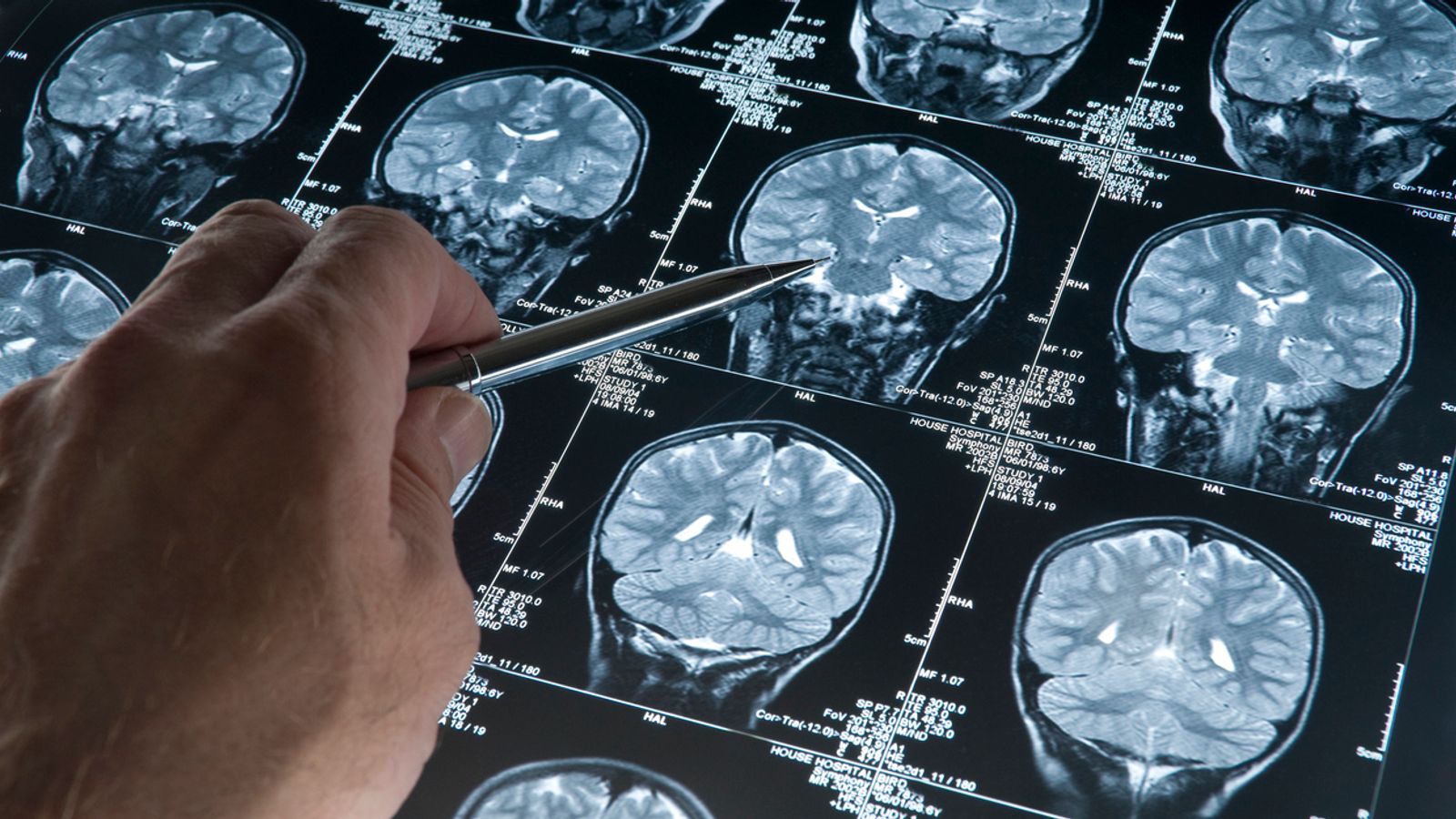 Alzheimer's: First drug to slow progression of disease gains approval of US regulator the FDA