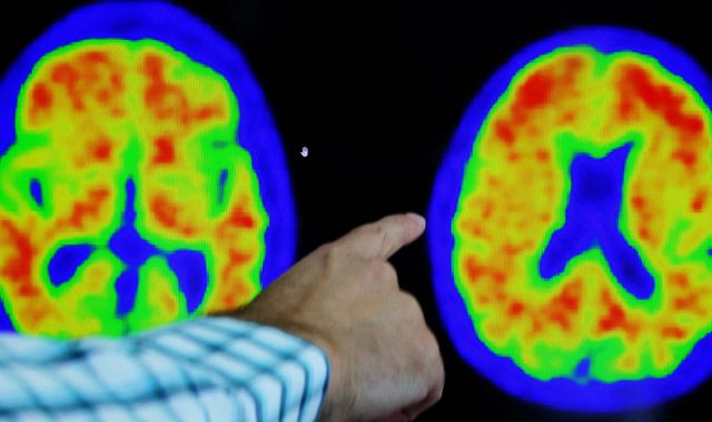 New drug found to slow Alzheimer's hailed a 'turning point in fight against disease' - Vimarsana News