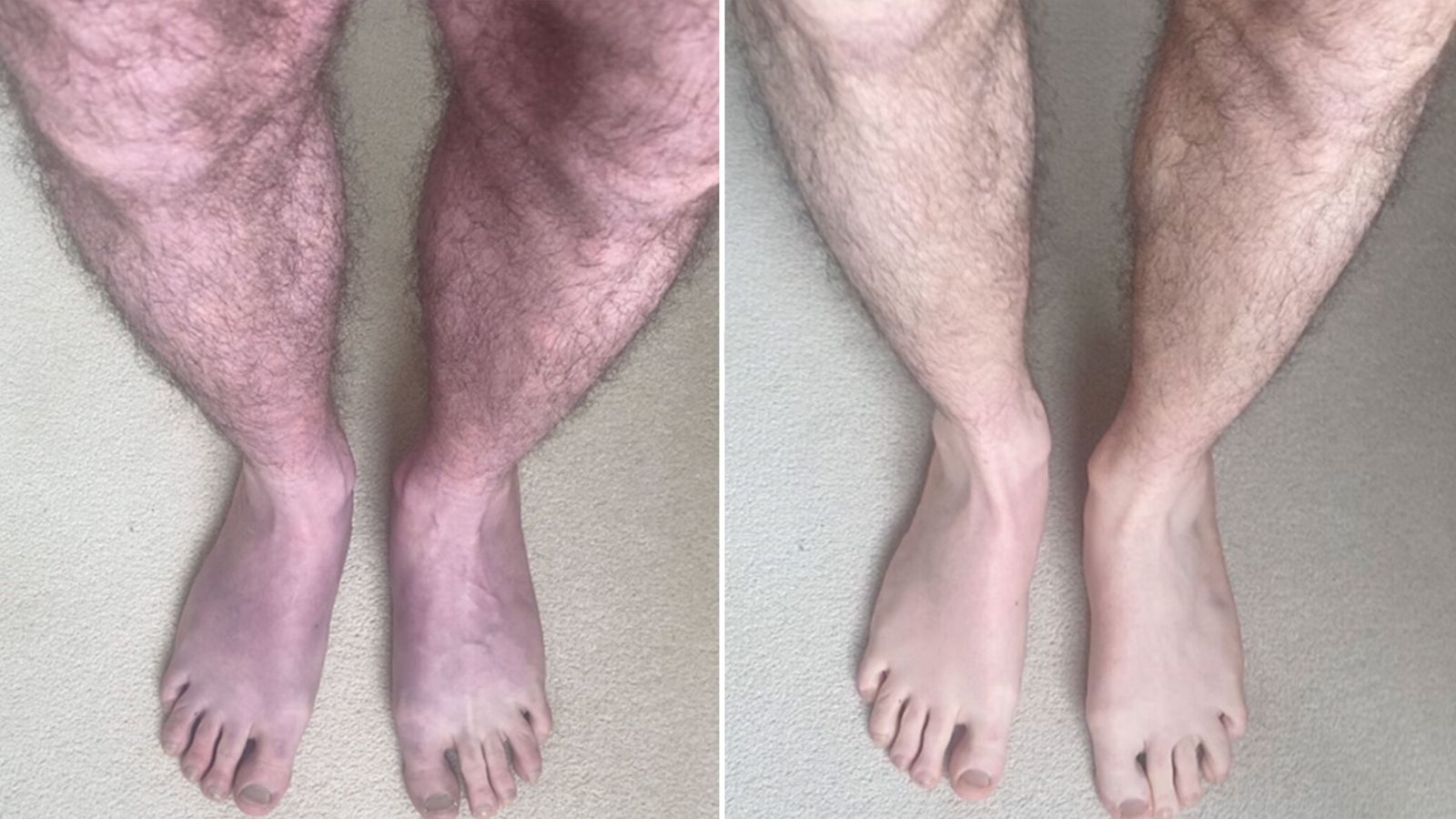 Long COVID: The unusual case that turns man's legs blue