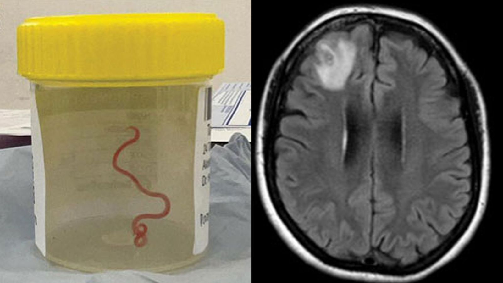Live worm found in woman's brain in world-first discovery