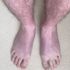 Man's legs turn blue after 10 minutes of standing up in unusual long COVID case