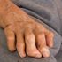 Leprosy on the rise and could be endemic in one US state - report