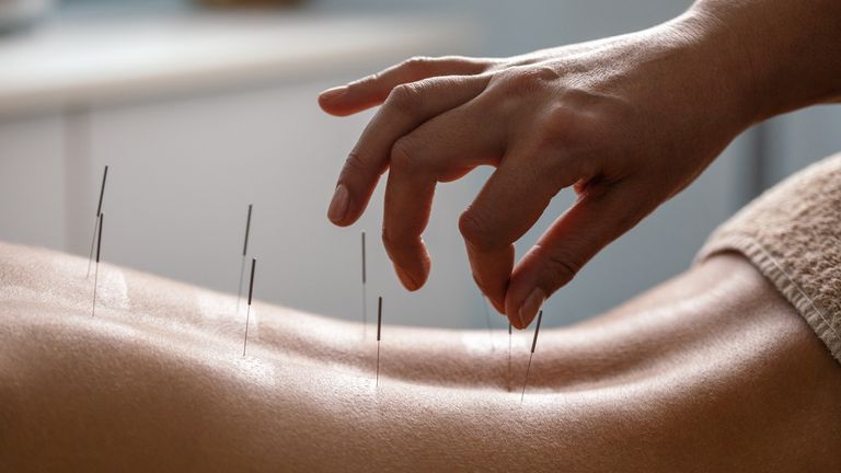 Acupuncture back treatment stock photo