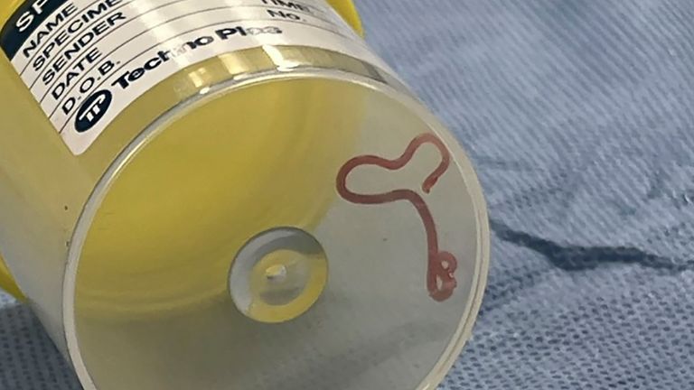 This undated photo supplied by Canberra Health Services, shows a parasite in a specimen jar at a Canberra hospital in Australia. A neurosurgeon investigating a patient&#39;s mystery neurological symptoms in an Australian hospital has been surprised to pluck a 3-inch wriggling worm from her brain. (Canberra Health Services via AP)