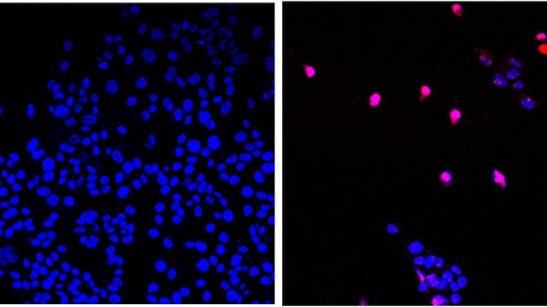 Untreated cancer cells can be seen on the left - and cells treated with the new drug are on the right. Pic: City of Hope 