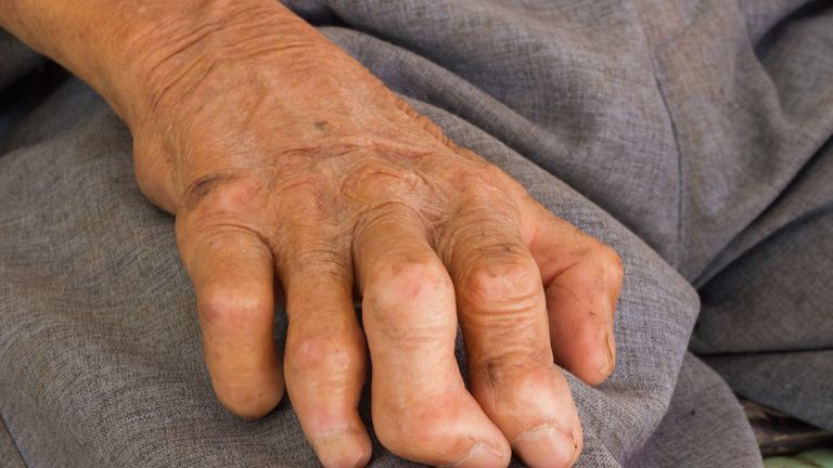 Leprosy in a person&#39;s hand