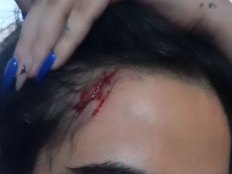Sonia shared this image of a wound on her head after she says she was abducted by Iranian security forces. Pic: @sonim_7