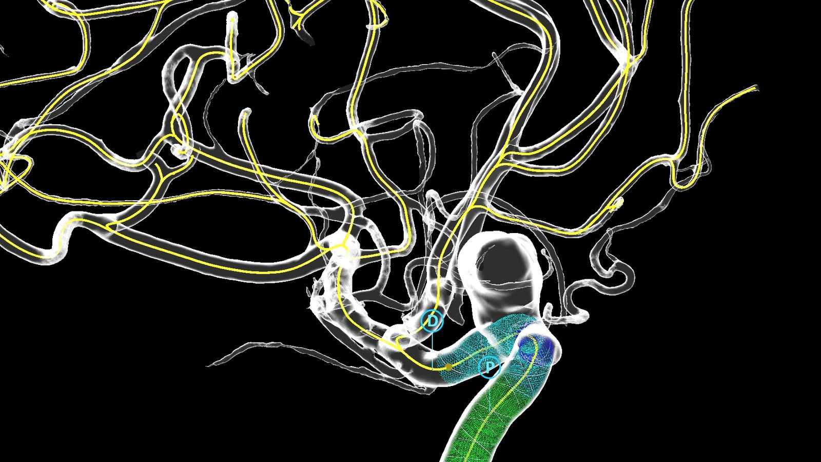 AIdriven tech could transform aneurysm treatment X PRESS