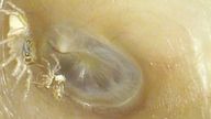 A small spider in a 64-year-old woman&#39;s ear canal, next to its discarded exoskeleton. Pic: The New England Journal of Medicine