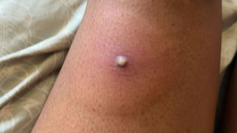 The ant bite on Rayanne&#39;s leg became infected