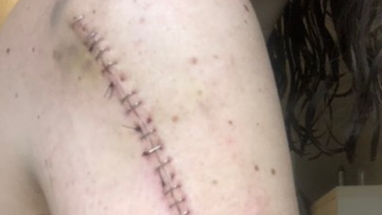 Megan Royle&#39;s arms after surgeons operated, believing she had skin cancer
