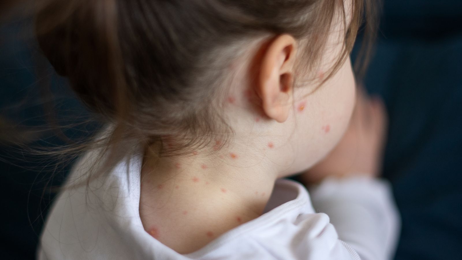 Measles: Urgent action needed to stop outbreak spreading across towns and cities, say health experts