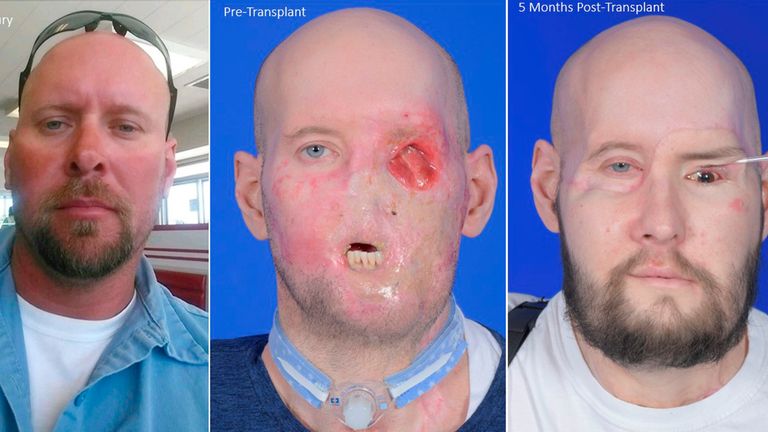 Aaron James&#39;s face was partially destroyed in a work-related incident. Pic: NYU Langone Health via AP