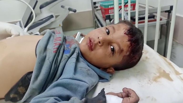 Injured child at the Gaza European hospital