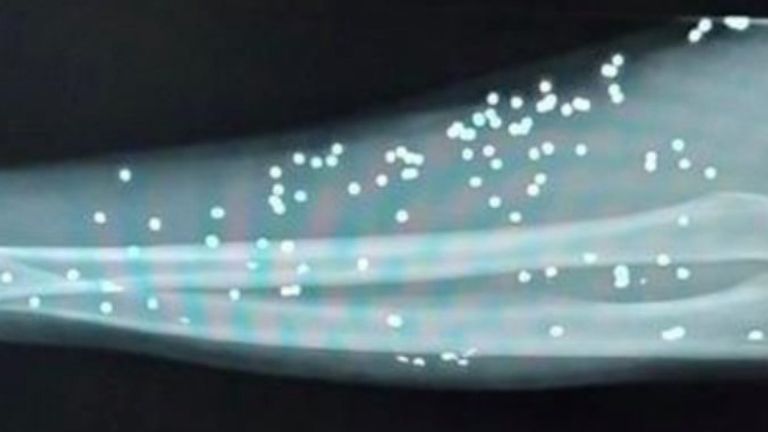 X ray showing bullet pellets 