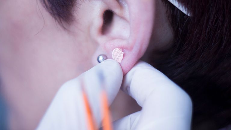 Auriculartherapy oriental acupunture ear seed sticker plaster auriculatherapy treatment physiotherapy. Pic: iStock