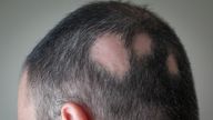 People with alopecia areata can find the condition very distressing Pic: iStock  