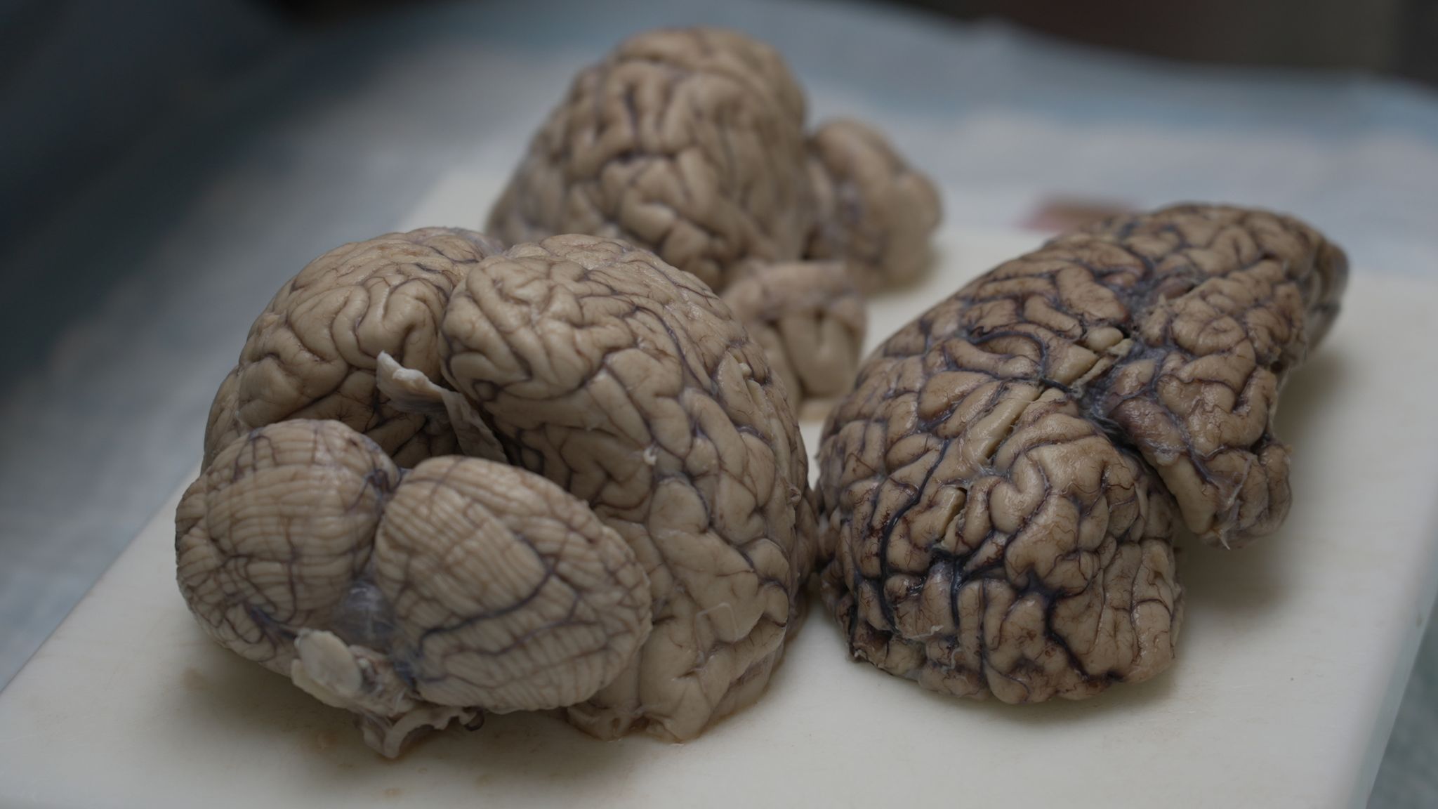 The human cost of brain disease hitting one of the world's most popular