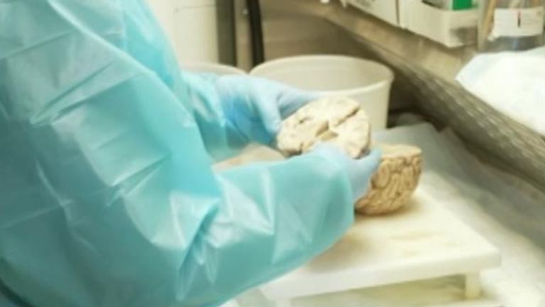 The National Sports Brain Bank in Pittsburgh analyses donated brains for evidence of CTE.