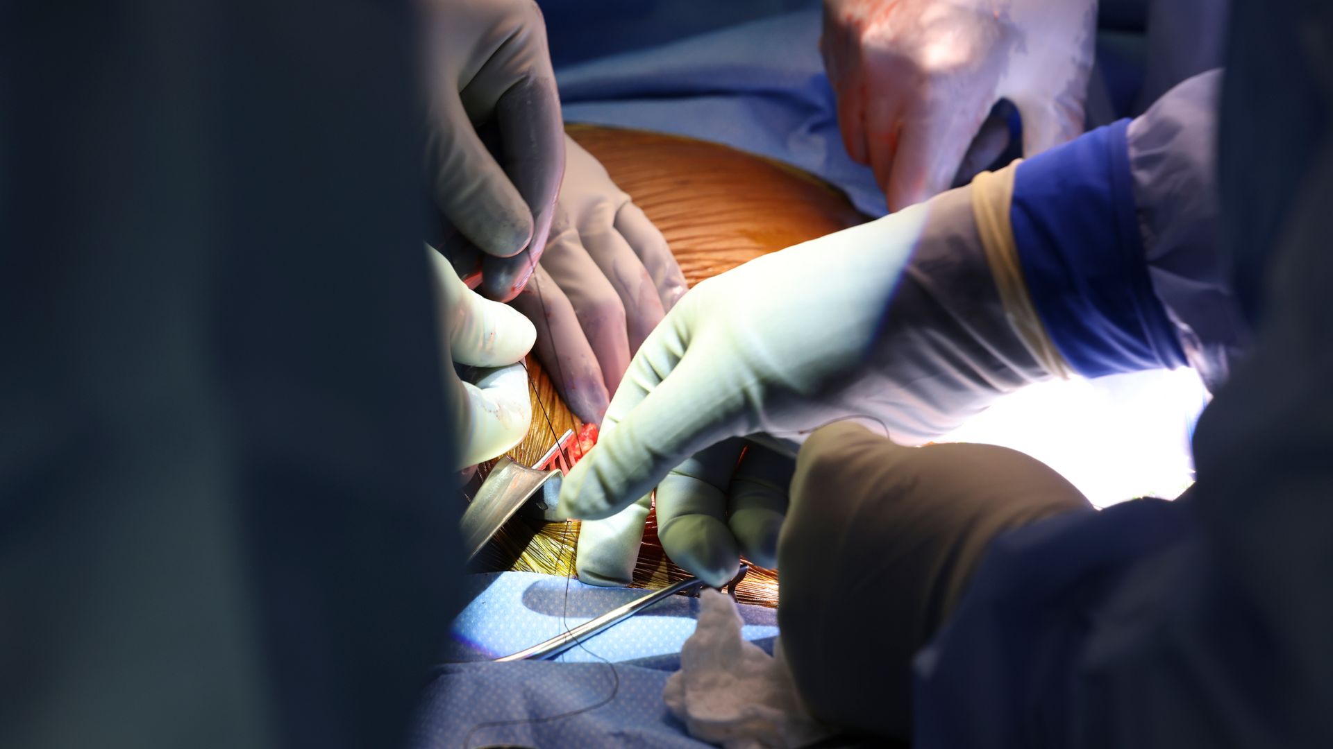 Patient who got pig kidney in world first dies