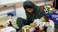 A Palestinian woman holds her twin malnourished daughter at a health centre in Rafah. Pic: Reuters