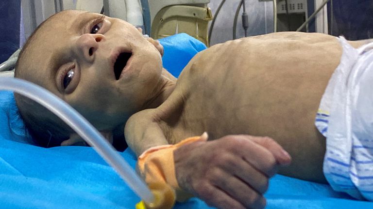 A malnourished toddler at Kamal Adwan Hospital in Gaza. Pic: Reuters
