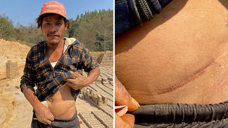 Suman sold his kidney - and shows his scar from the procedure