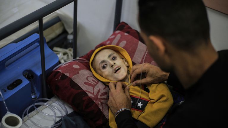 A malnourished hospital patient in Gaza. Pic: AP