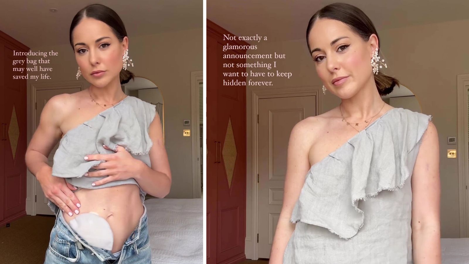 Louise Thompson reveals stoma bag after months of health problems: 'It may well have saved my life'